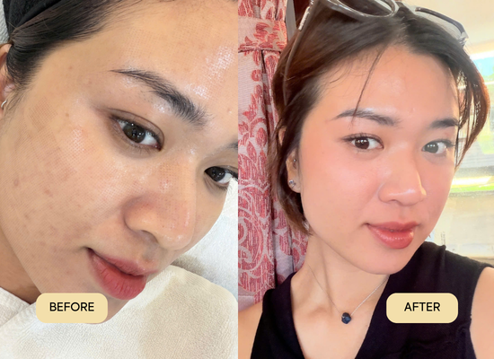 SKIN RENEW: TÁI TẠO BỀ MẶT, CẢI THIỆN CHẤT LƯỢNG DA